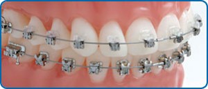 damon braces 3 discover dental